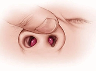 Burunda Kemik Erimesi Belirtileri ve Tedavisi Burunda Kemik Erimesi Belirtileri ve Tedavisi